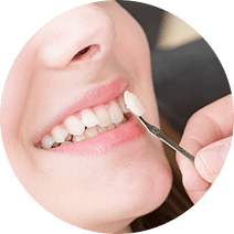 Dental Veneers Leicester Dental Veneers Leicester